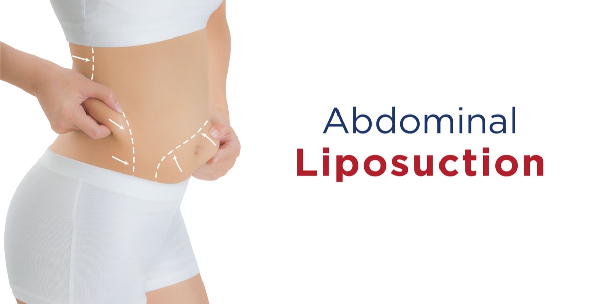Abdominal-Liposuction