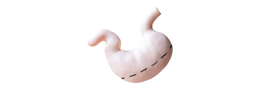 Gastrectomy