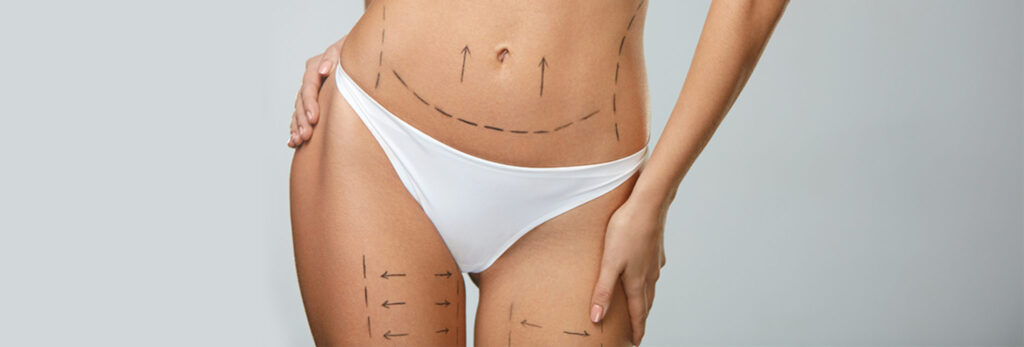 Liposuction
