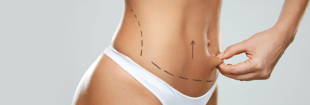 Abdominoplasty