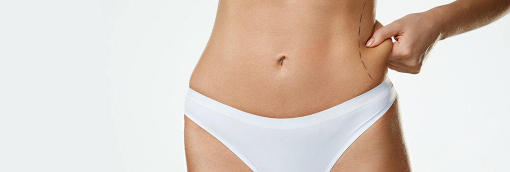Belt Lipectomy